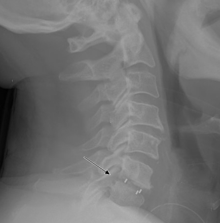 Rx cervicale ernia del disco