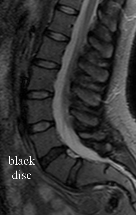risonanza magentica Dolore lombare e black disc