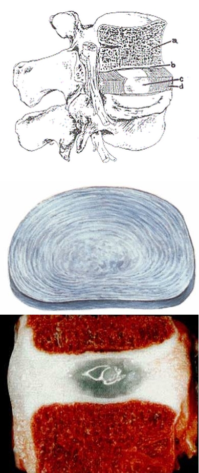 Disco vertebrale
