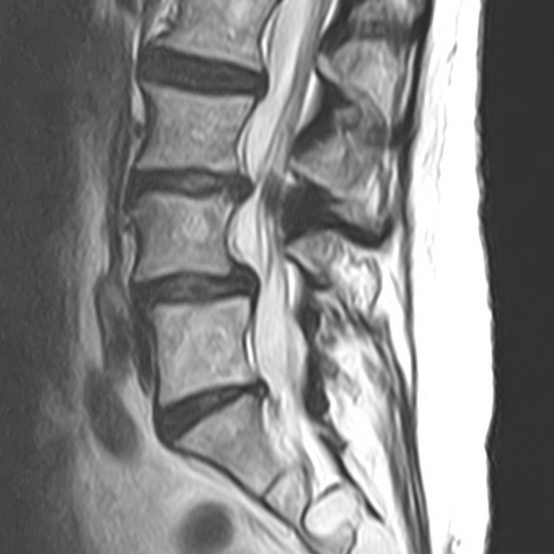 Spondilolistesi lombare