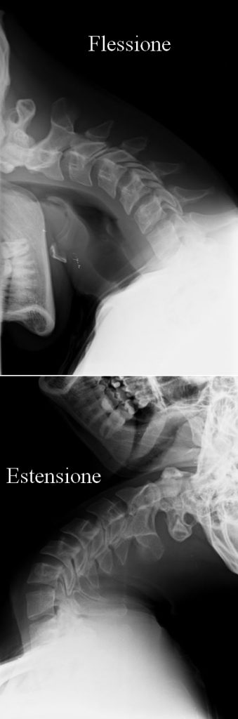 radiografia cervicale dianmica per mielopatia