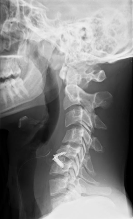 discetomia cervicale