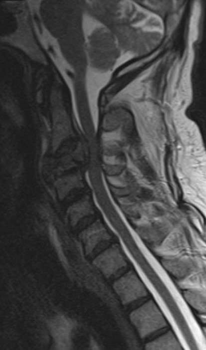 Tumore vertebrale RM