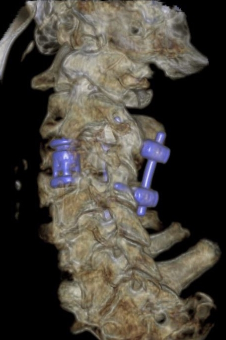 Tumore vertebrale tc post-operatoria
