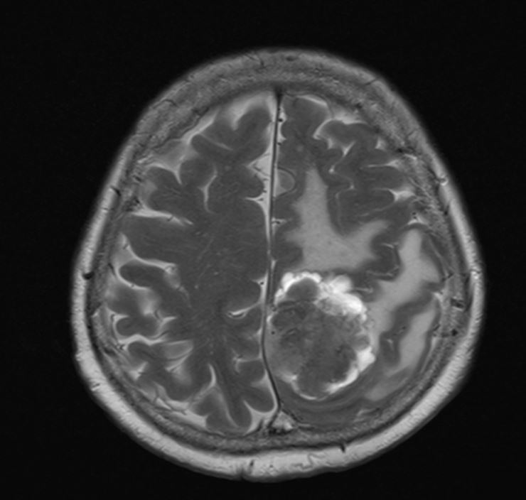 Meningioma parietale all'esame di risonanza, sequenza T2. Evidente l'edema perilesionale