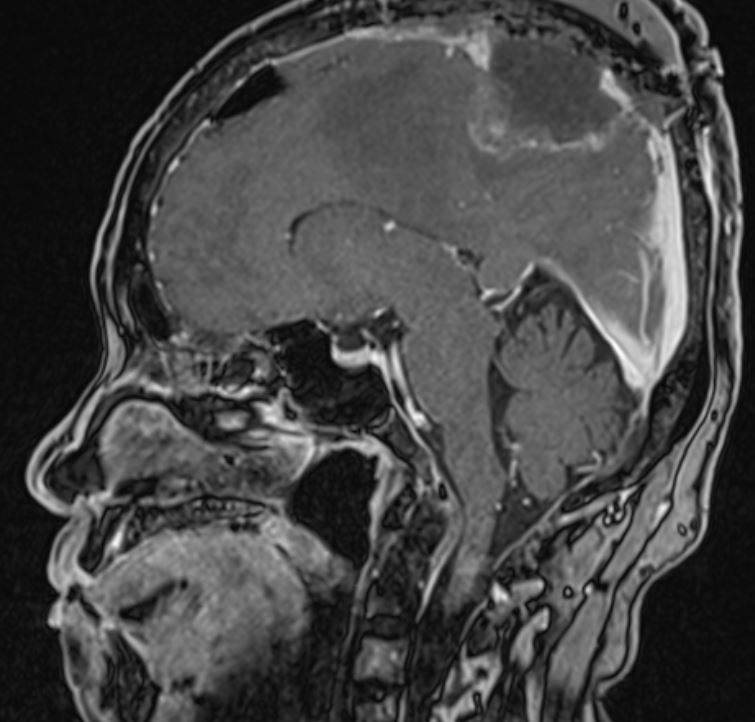Asportazione completa del meningioma ad un esame di risonanza con mezzo di contrasto dopo la procedura chirurgica