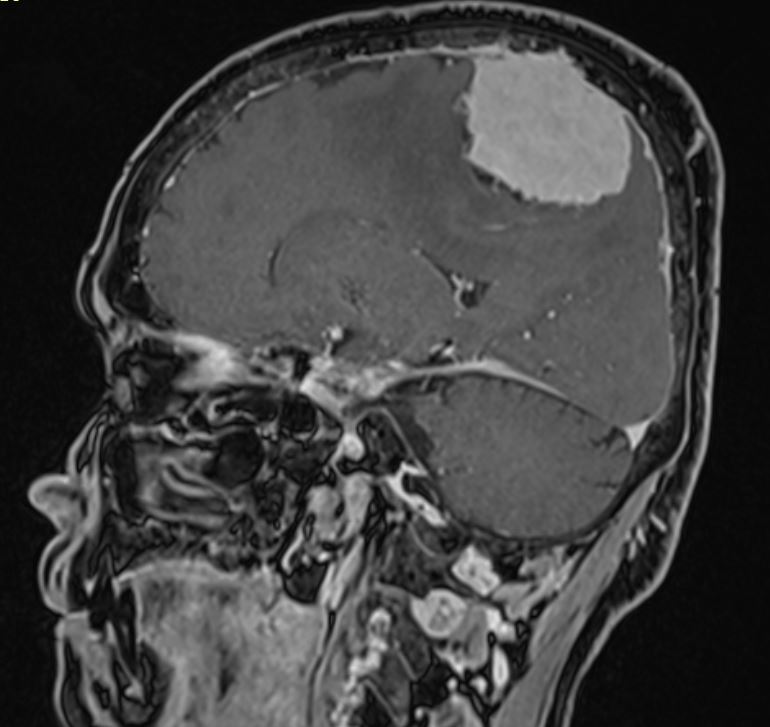 Voluminoso Meningioma cerebrale parietale all'esame di risonanza con mezzo di contrasto