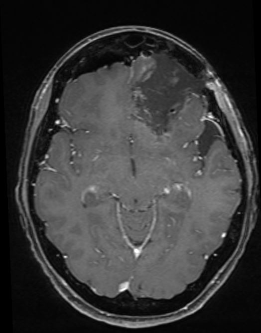 Risonanza magnetica dopo asportazione completa del glioma cerebrale