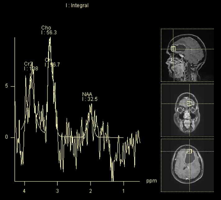 Glioma cerebrale all'esame di spettroscopia di risonanza magnetica
