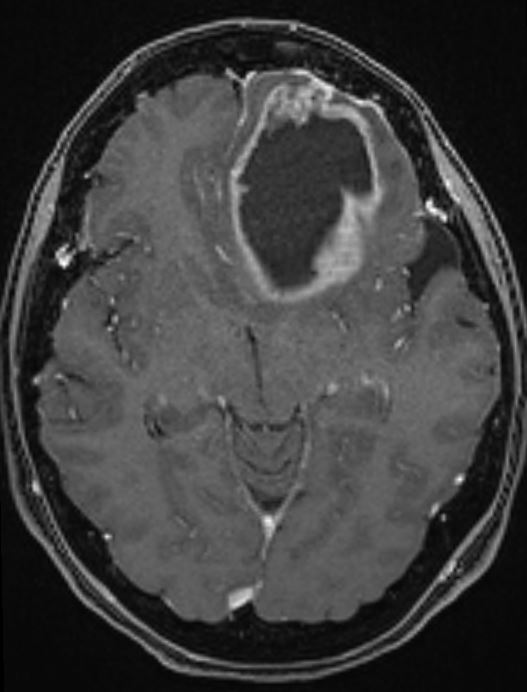 Glioma cerebrale frontale all'esame di Risonanza Magnetica con contrasto